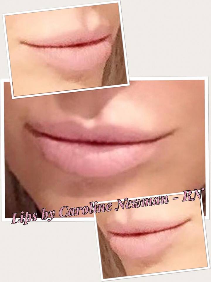 Dermal Fillers for Lips