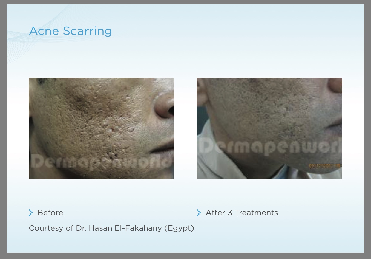 Dermapen Treatment before and after 2