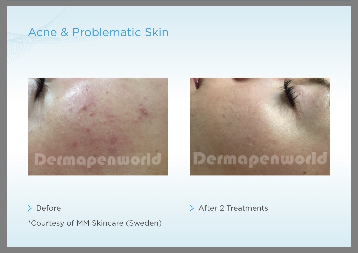 Dermapen Treatment before and after 1